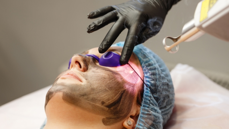Carbon Laser Facial Course